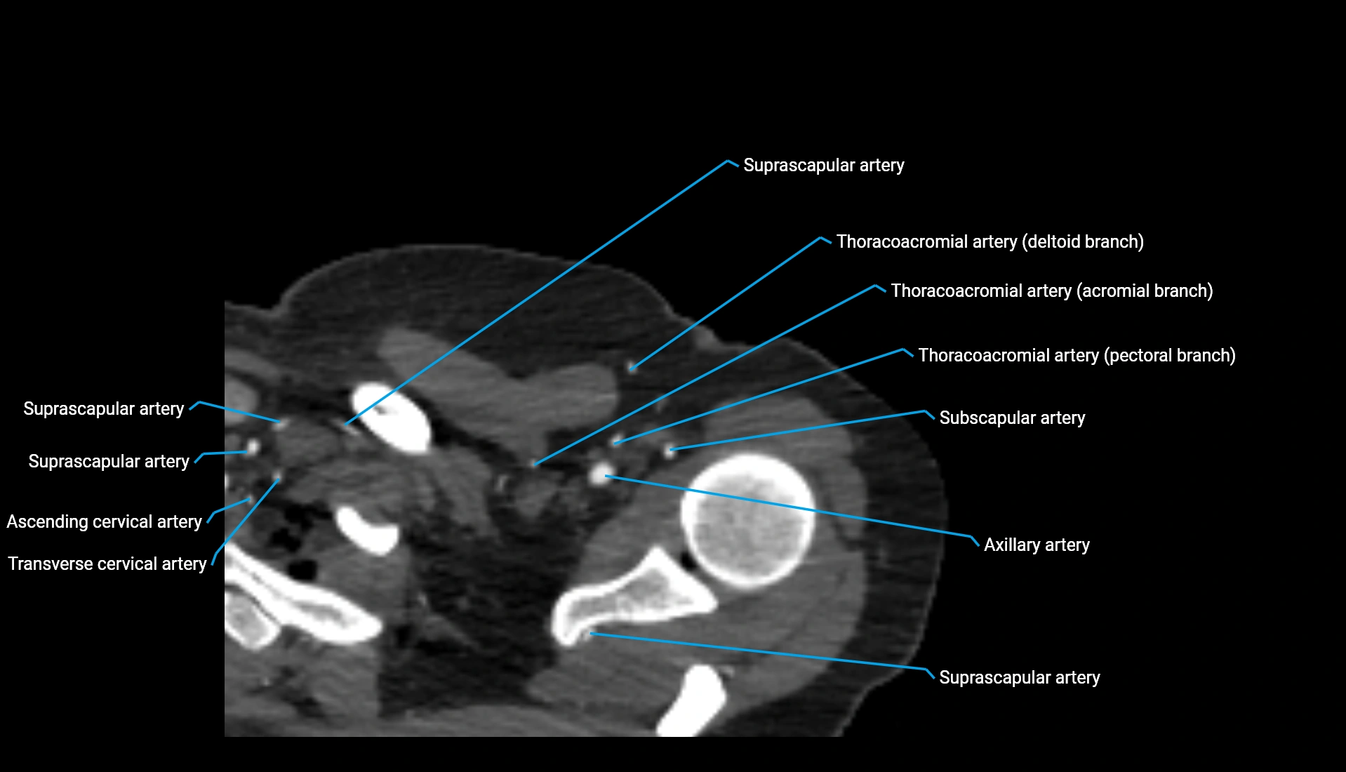CTA upper limb axial cross sectional anatomy labelled image 330 (1).webp